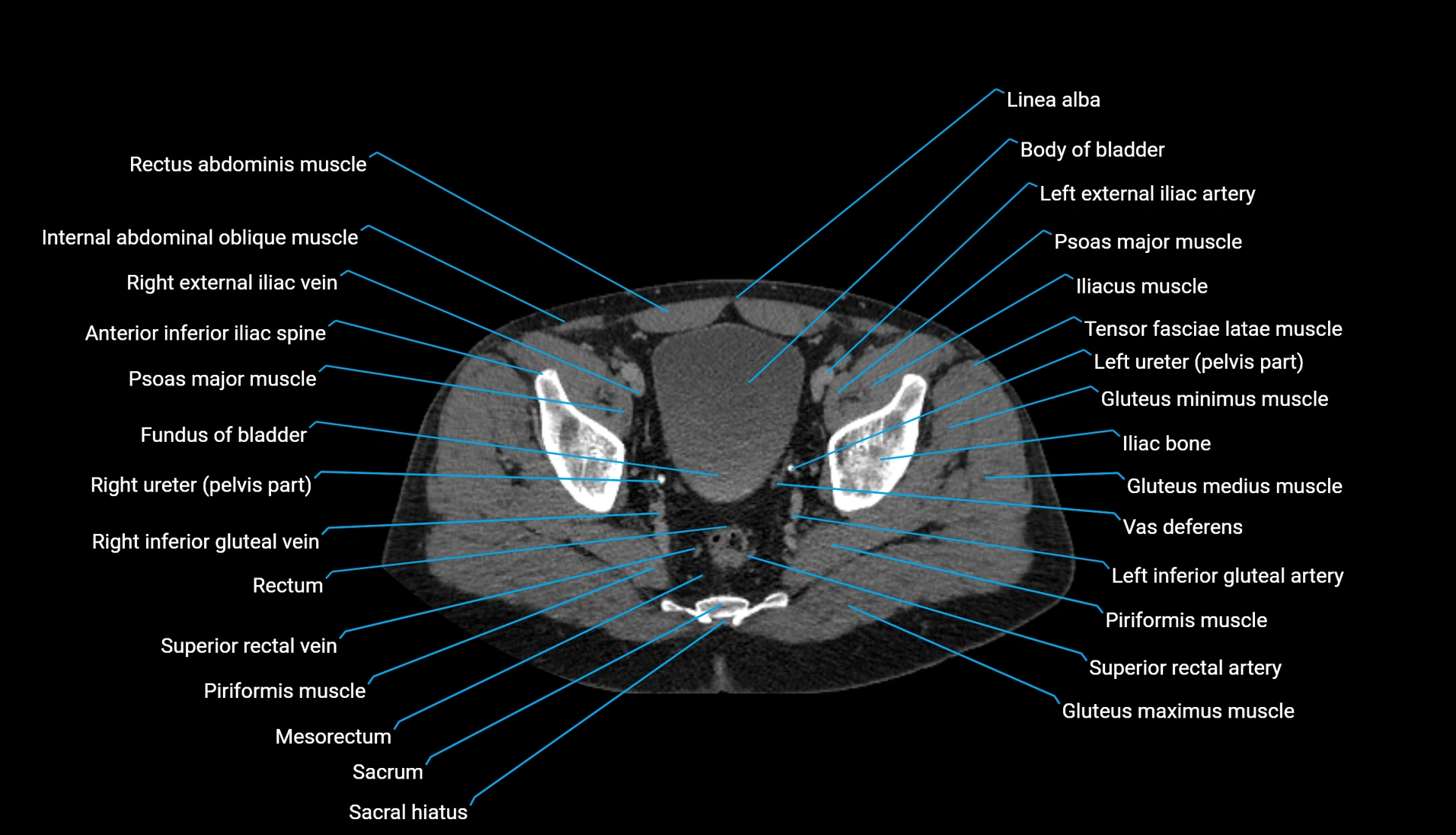 CT urogram axial cross sectional anatomy  labelled radiology image-00215.webp